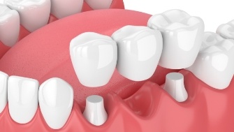 Animated smile during traditional dental bridge placement