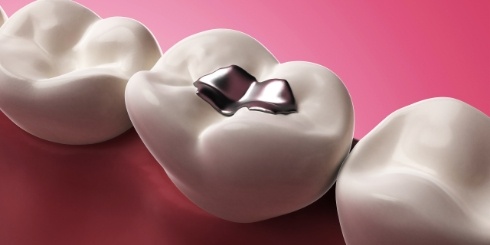Animated tooth with metal filling